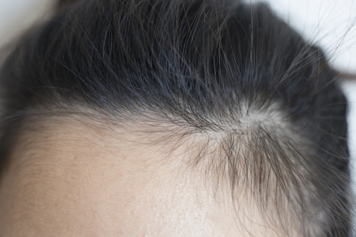 産後や更年期の抜け毛には「カルシウム」が効果的。その理由とは？